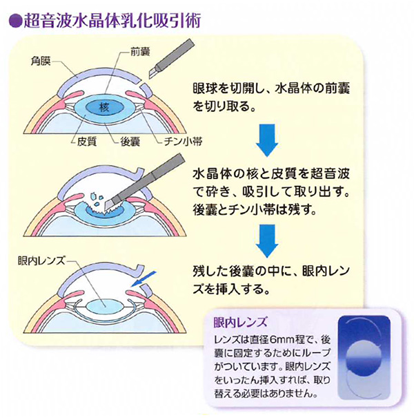 白内障 術 後 の 通院