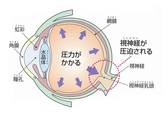 眼圧について